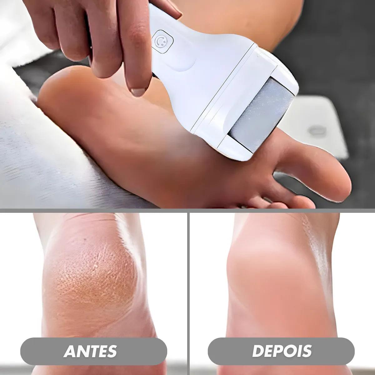 Pedicure Pro 360 - Lixador Para os Pés